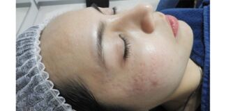 4 Jenis Bekas Jerawat dan Cara Mengobatinya